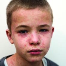 Child with measles